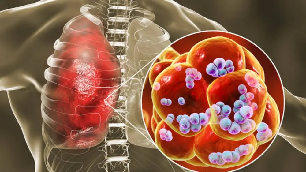 Phế cầu khuẩn gây ra nhiều bệnh nguy hiểm